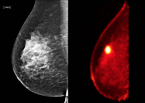 the positron emission tomography (PET) scan is a specialized imaging test that can detect cancerous 