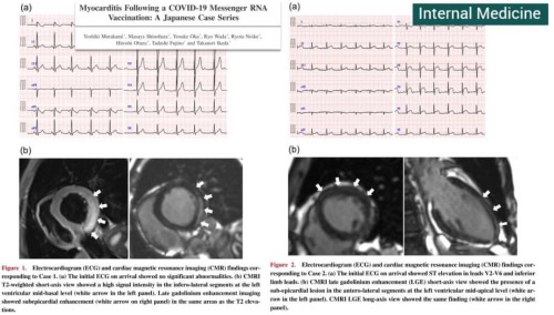 #Telegram #NessunaCorrelazione
Due casi dal Giappone di miocardite seguenti dopo Pfizer: Maschi di 27 e 38 anni.
jstage.jst.go.jp/article/internalmedicine/advpub/0/advpub_8731-21/_article
“Gli esiti a lungo termine della miocardite correlata al...