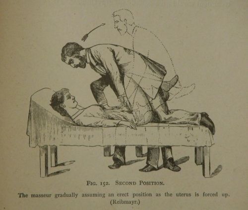 ratak-monodosico: Uterine Massage. Manual repositioning was the office treatment for a retroverted u