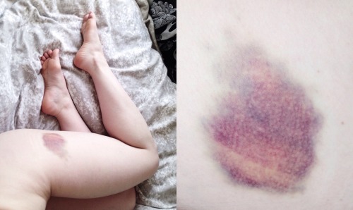 Sex Bruise watch // day 5 pictures