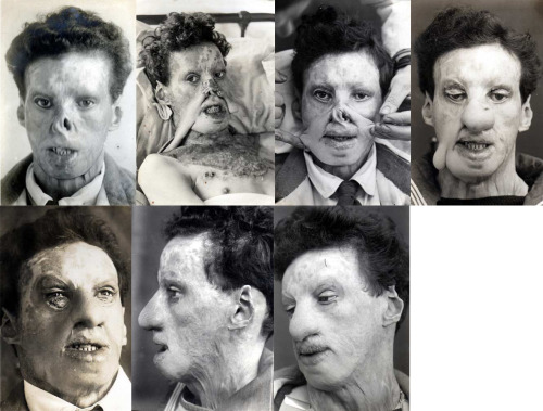 Early attempts at facial reconstructive surgery for soldiers disfigured in WW1