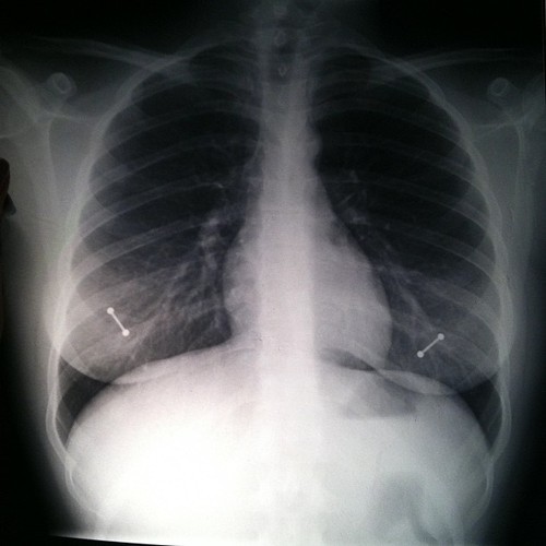 fuckyeahsexanddrugs:  Just wanted to show off my healthy lungs and heart. Also, my