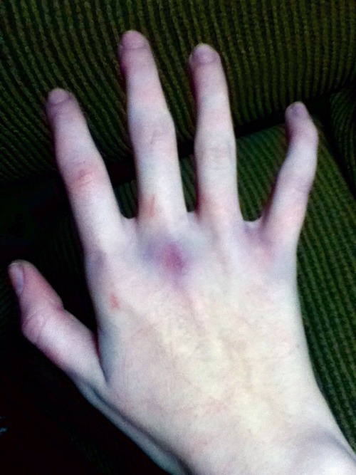 zoneblues: remember when i found out i could punch and my knuckles bled