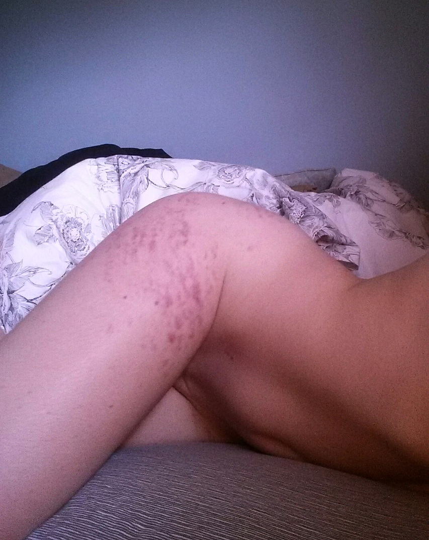 pumpkinspicedslut:  These bruuuuises make for better conversation  