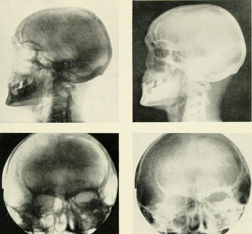 Radiography, x-ray therapeutics and radium therapy, 1916