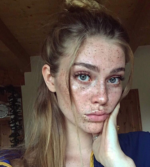 yesgingerfriend: gewelmaker: Swalina Tolle Sommersprossen 239 freckles, each as lovely as the others