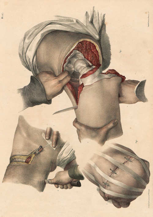 Traité complet de l'anatomie de l'homme: comprenant la médicine opératoireDigit