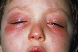 voulx:    conjunctivitis (pink eye)   