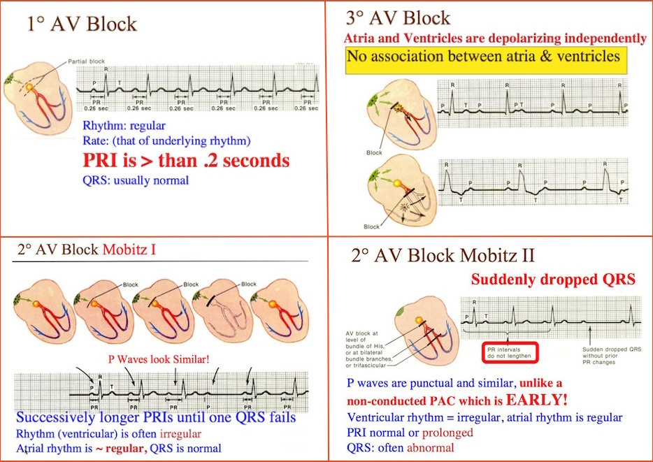 Atrioventricular Blockin Atrioventricular Av Block Or Heart Block