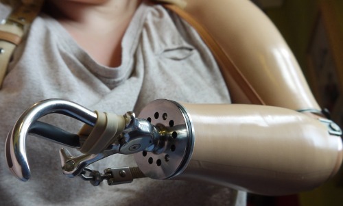 Close up of an above elbow prosthetic with hook