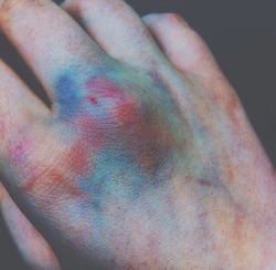 grungexteenx:  Bruises fascinate me lol idk