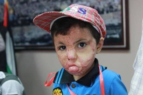 famee:  merelypassion:  golden-spoon:  beinpalestine:  This is what ‪Israel‬ inflicts on children in ‪Gaza‬. But it doesn’t matter to the media because ‪US‬ is an ‪Israeli‬ client  ياارب احرق اليهود، يارب اشوف