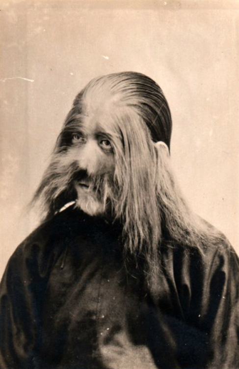 Homme atteint d'hypertrichose (pilosité envahissante sur une partie du corps ou sa totalité, aussi appelée “syndrome du loup-garou”), Japon,1890.