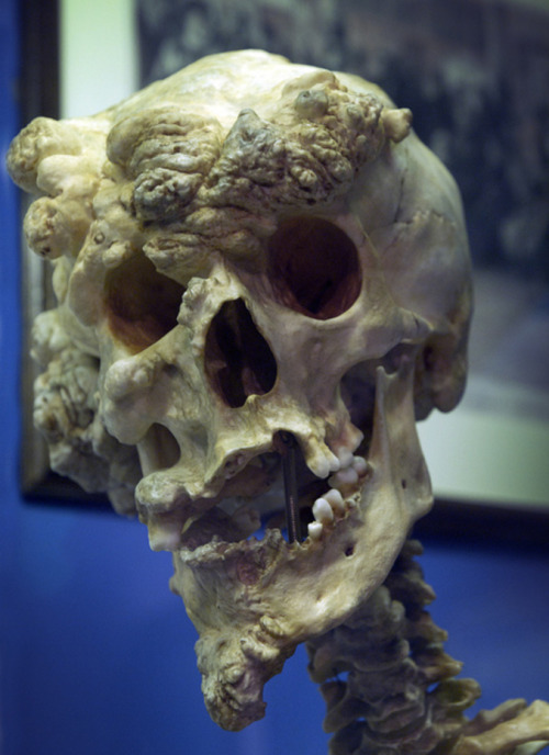 unexplained-events:Skull of Joesph Merrick (Elephant Man)