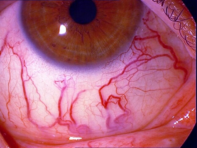 coma-kidd: Carotid-cavernous fistula 