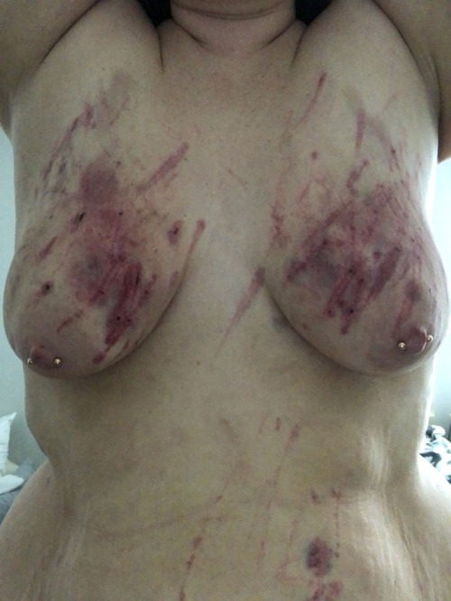 inquisitorialfox: poppabear47: Bruise progression on my peach.. day 2 Bites, paws, whips and dragon 