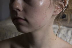 femme-cutie:  I love my acne kissed skin