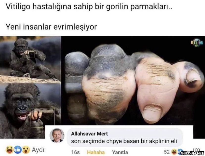 Vitiligo hastalığına sahip...