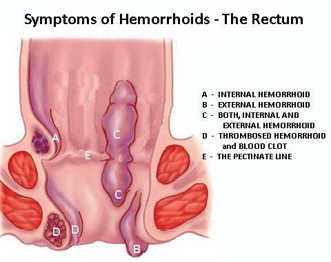 Whatispsoriasis101 Symptoms Of Hemorrhoids What Exactly Causes