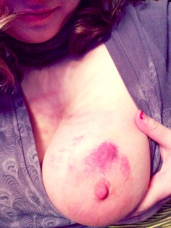 degrader-daddy:  boobs-butts-and-beyond:  Pretty bruises! 😍