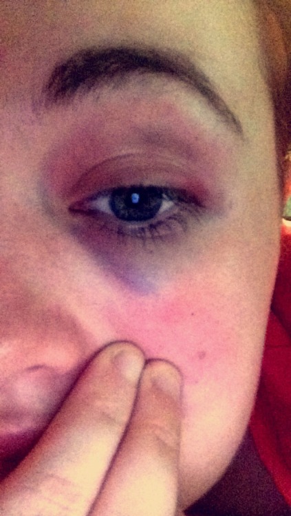 I wish I could say I got this doing somthing cool like getting in a bitch fight but I ran into a door lol
