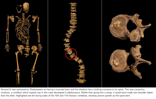 medievaliz:royalwatcher:Richard III: The twisted bones that reveal a kingFirst images from Daily Mai