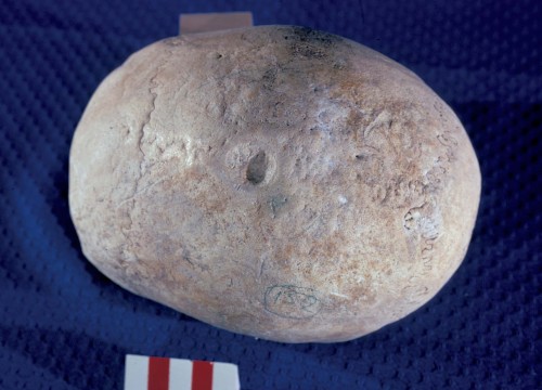 Cranial depression (top) and healed crater wounds 