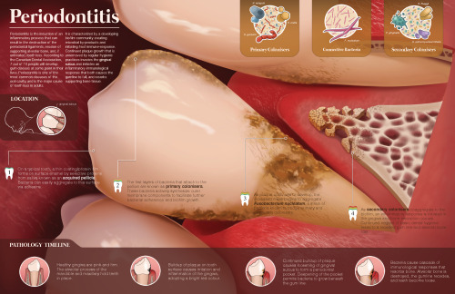 Periodontitis | November 2016Two-page spread on the characterization and development of periodontiti