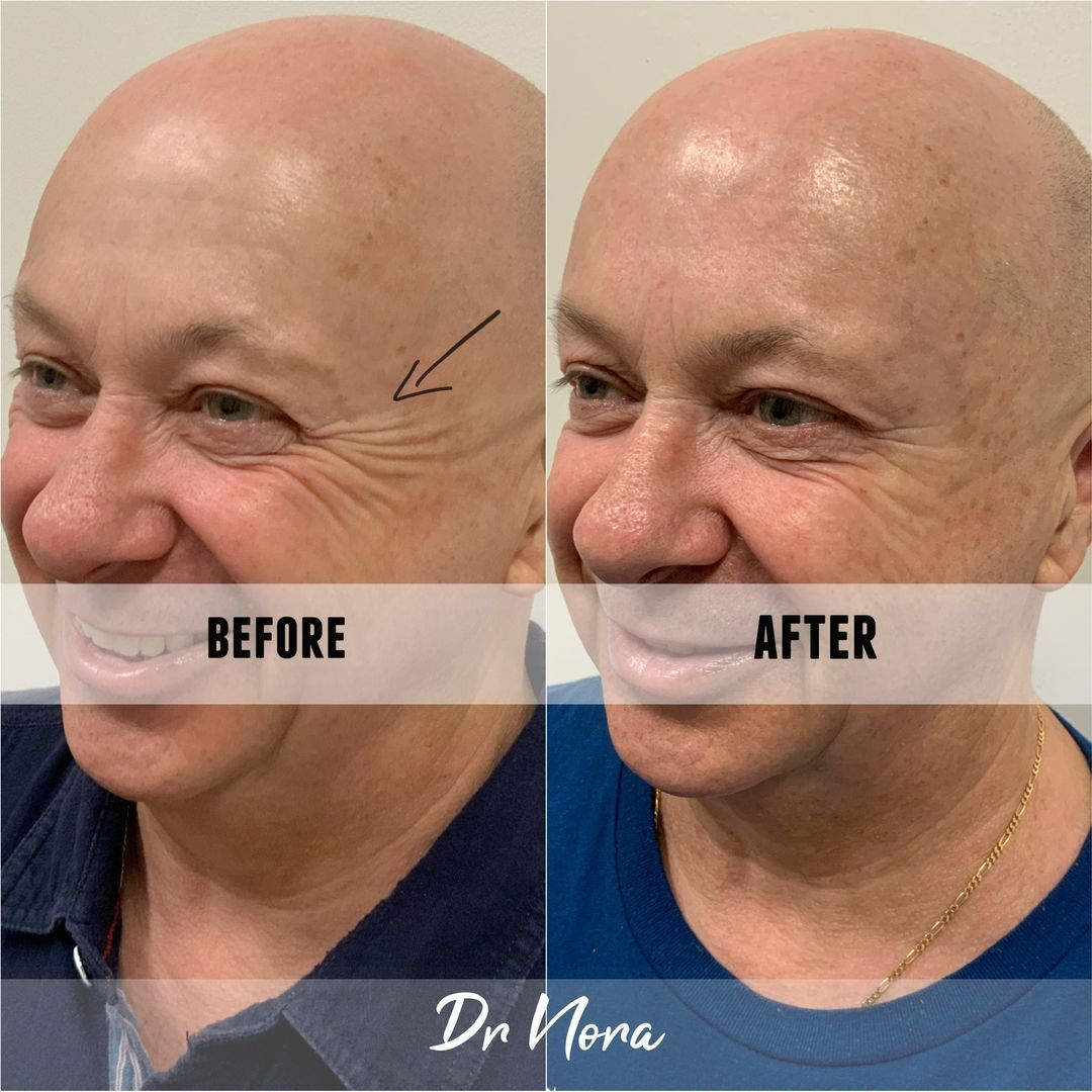 Anti-wrinkle treatment of smile lines 😆Anti-wrinkle therapy is a way to reduce the appearance of strong and deep lines around the eyes. Treatment time is 15 minutes, optimal results are seen at 2 weeks and lasts up to 3-5 months.
If you have any...