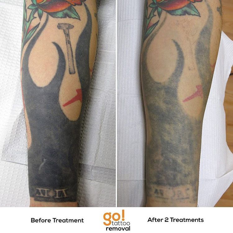 GO Tattoo Removal  Thick black tribal is now in the way of how this