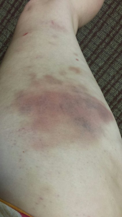 Day 0 of the giant thigh bruise I earned on Saturday and into Sunday. During the scene we had on Sat