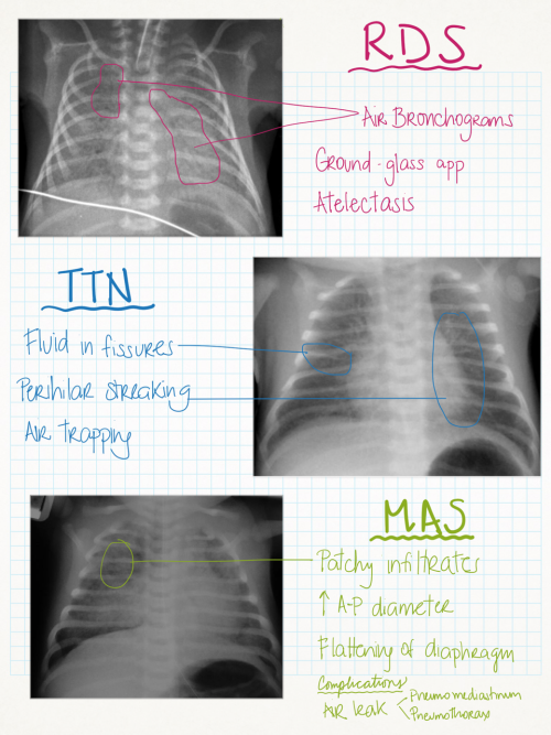 Newborn Respiratory Distress