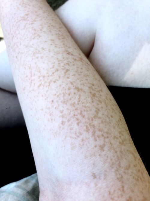 william-snekspeare:I went Outside today which makes my freckles emerge from the depths That’s a weird snake