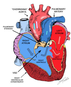 cluelessmedic:  Tetralogy of Fallot Pulmonary Stenosis Right Ventricular Hypertrophy Ventricular Septal Defects Overriding Aorta (overrides a VSD) most common cause of cyanotic congenital heart disease signs - clubbing, loud ejection systolic murmur