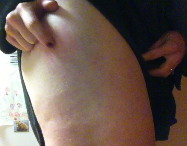 mycloudyskies:  thick thigh thursday skeeter bite :(  nice thighs
