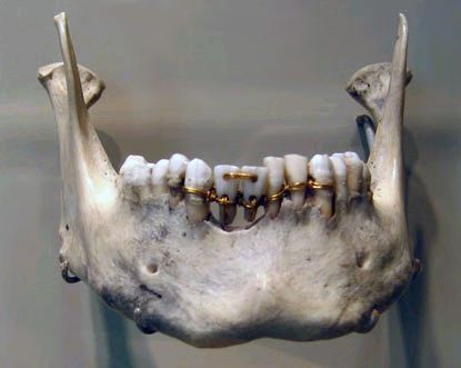 congenitaldisease:  This image showing dental work on a mummy from ancient Egypt is evidence of anci