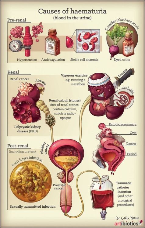 medicalbasics:causes of blood in the urine (haematuria) #medschool #doctor #medicalstudent #medicals