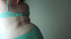 lingeringkisses:  I was embarrassed about my scars for so long. My doctor even made me feel ashamed when I would in for my check-ups. I have them on my chest too. Over the past few years, I’ve come a long way to accept my body, but these have been the