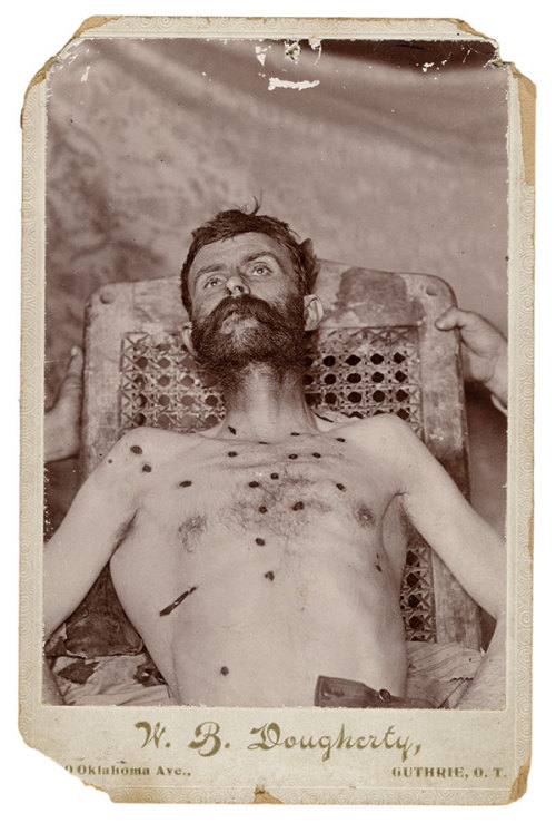 Postmortem of outlaw “Buckshot” Bill Doolin, Oklahoma Territory, 1896.from True West Magazine