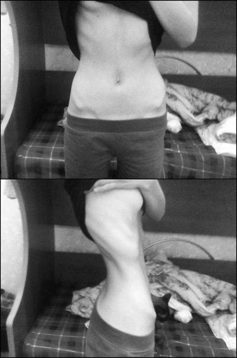 anorexicloser: ⭐️
