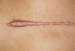 trinaechidna:  Keloid scar. 