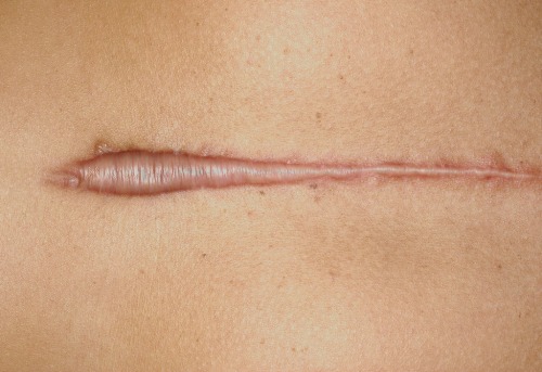 trinaechidna:Keloid scar.