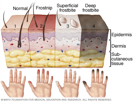 Tissue necrosis from im injection