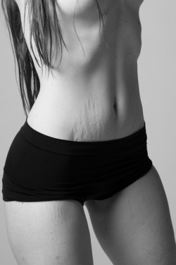 booksfoodmusic:  Picture from A Beautiful Body Project. Seeing as there are so many pictures of girls with flawless, fair skin all over tumblr, I just wanted to share this picture I saw showcasing the a body slightly different from the ones we see over