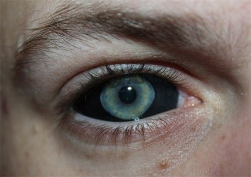 sixpenceee:  Corneal tattooing is when someone gets a tattoo on the cornea of their eye. Generally in most procedures, the dyeing agent is applied directly to the cornea. India ink is the most commonly used, providing safe and long-lasting effects.