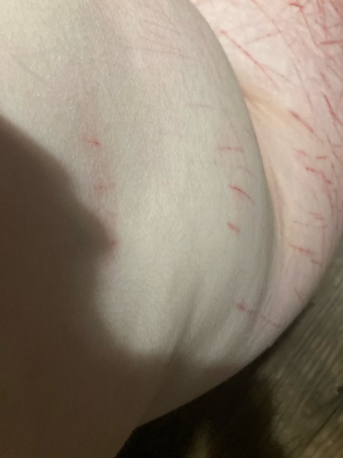 TW Self Harm!