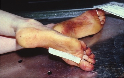congenitaldisease:  This is early mummification with drying of the feet. 