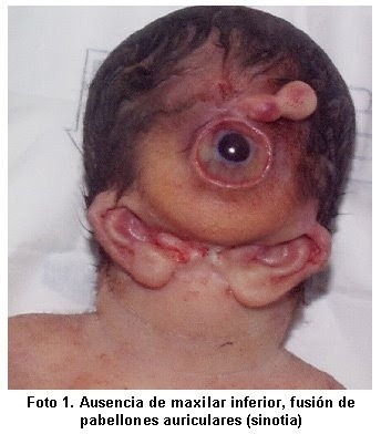 agnathia [no jaw] holoprosencephaly complex