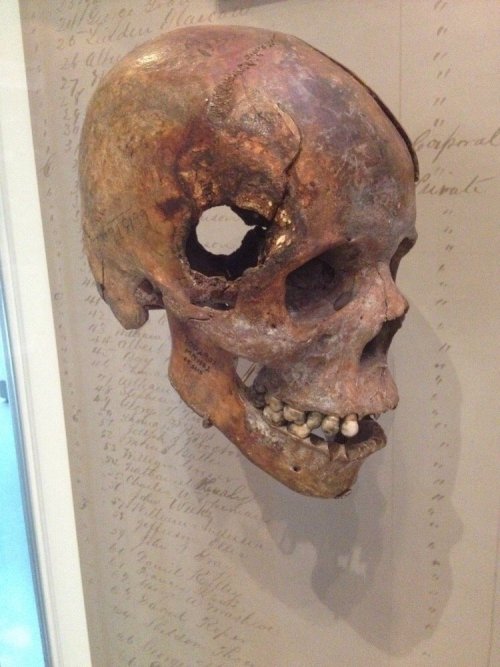 sixpenceee:  Skull from Civil War, this fatal wound was inflicted by an exploding 12 pound artillery shell