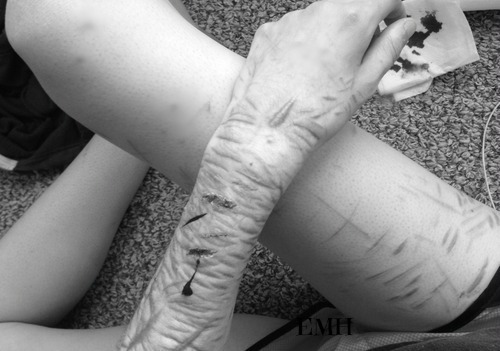 suicida-garota:  Você começa com um corte e diz que só vai ver qual é a sensação. Ai na segunda vez diz que vai ser a ultima, na terceira finge que esquece das ultimas palavras que disse a si mesma e faz novamente, quando ver não tem mais volta